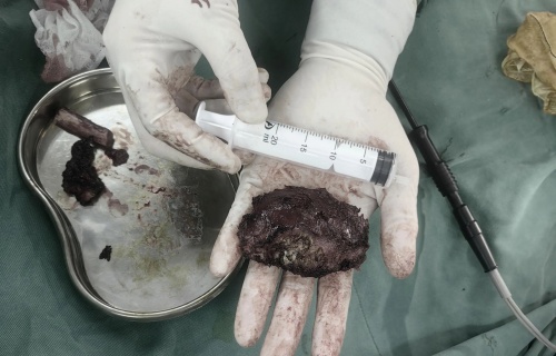 案例丨出血量仅100ml！我院微创手术再升级